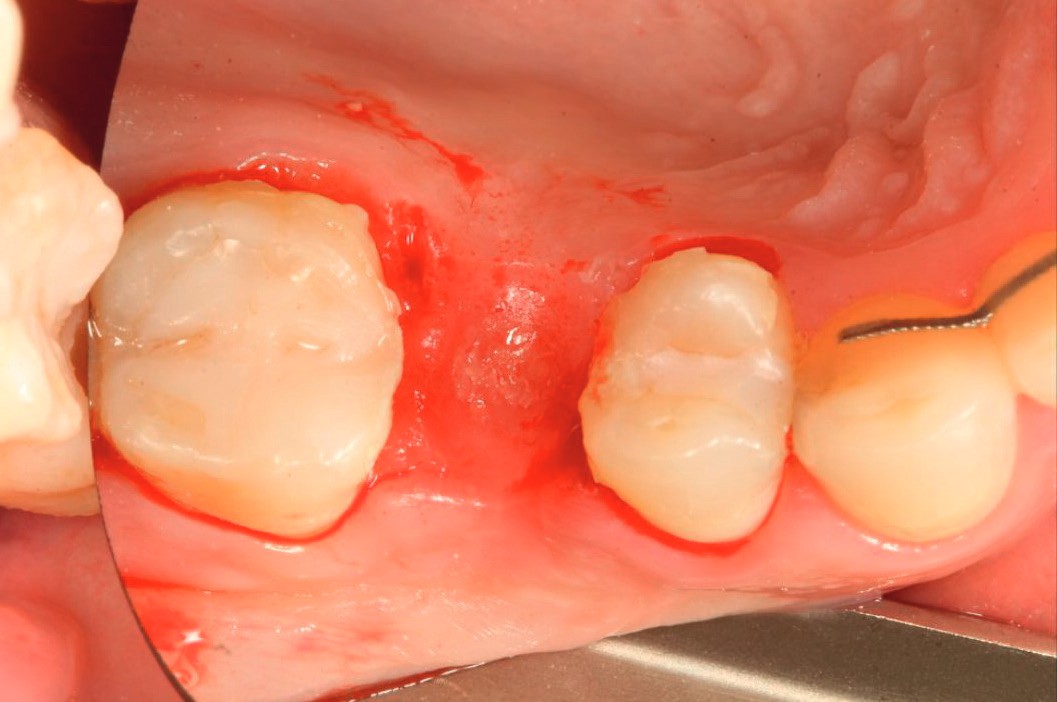 Healed ridge three months after augmentation, occlusal view