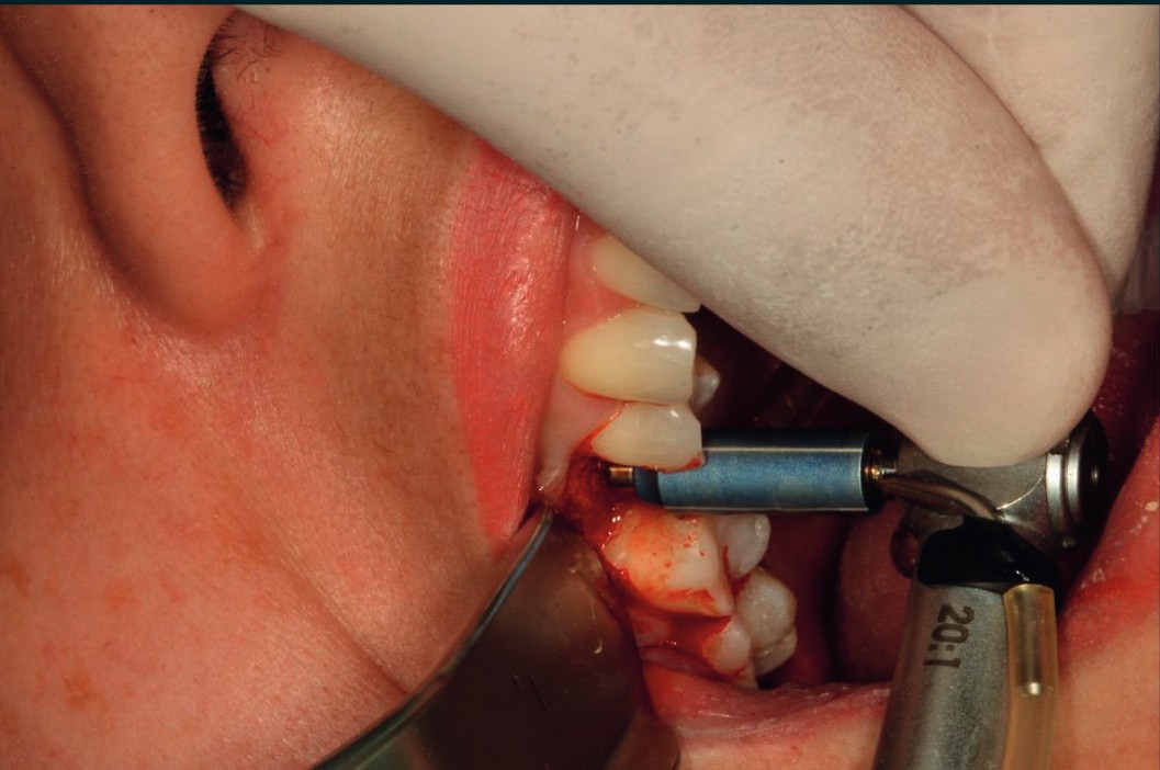 Pilot drill marking the osteotomy center