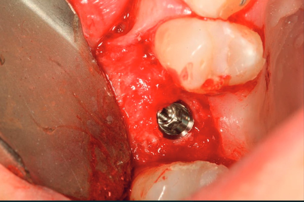 PCA implant seated in the osteotomy