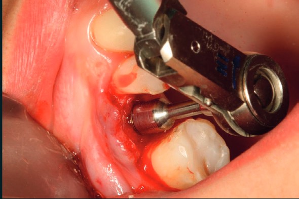 Hand ratchet torquing the i-base to 35 Ncm