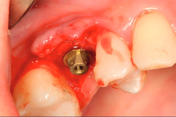 i-base seated on the implant, occlusal view