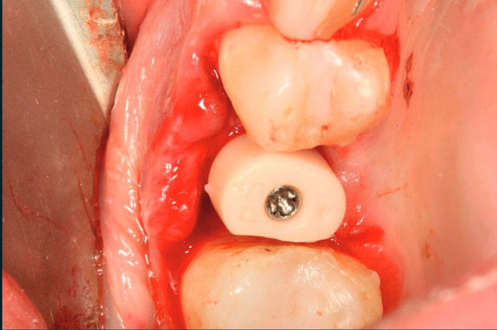 Premolar iCervico healer seated on the i-base