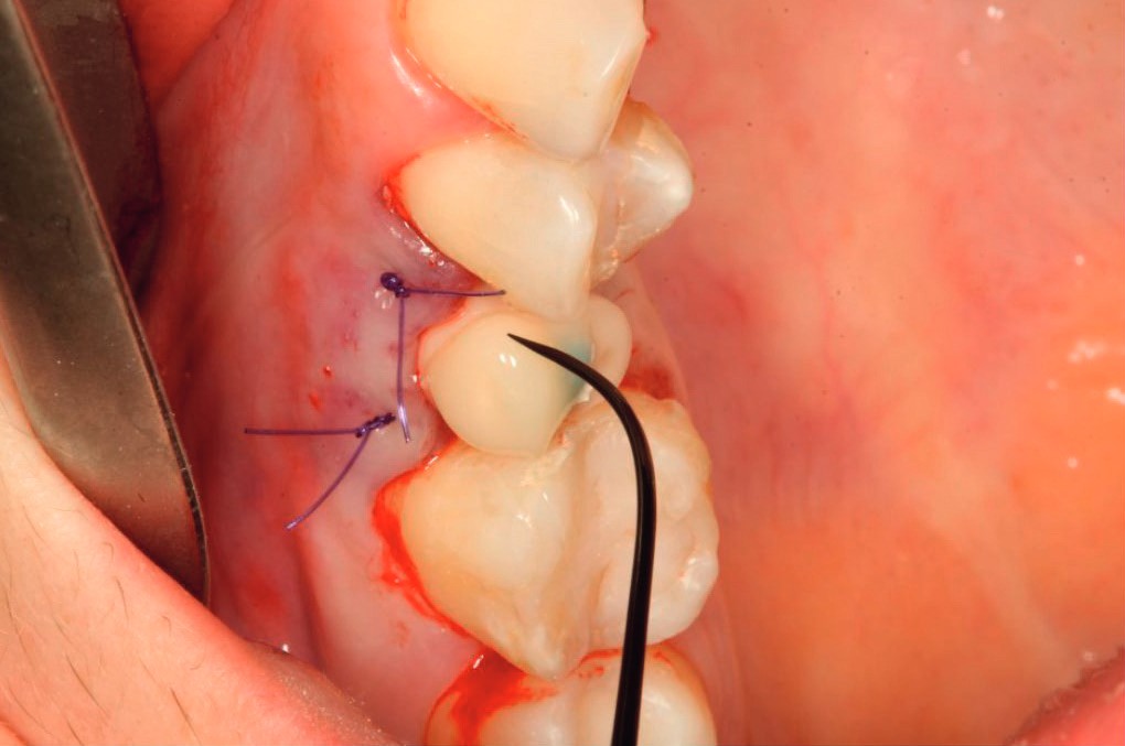 Immediate resin provisional on the healer, occlusal view