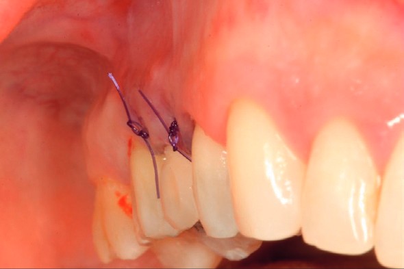 Immediate provisional, buccal view
