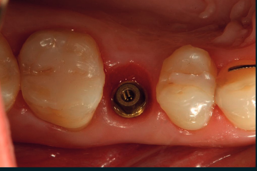 Shaped soft tissue emergence profile around the i-base