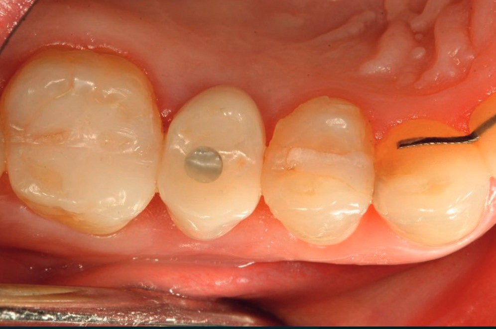 Final crown in place, occlusal view
