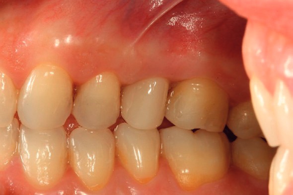 Final restoration in occlusion, buccal view